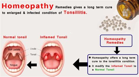 6 Best Homeopathic Medicines For Tonsillitis Treatment Homeopathy