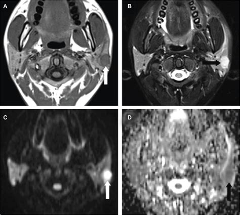 Tuberculosis Of The Parotid Lymph Nodes Clinical And Imaging Features