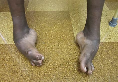 Complex Foot Deformities A Case Study Mayo Clinic
