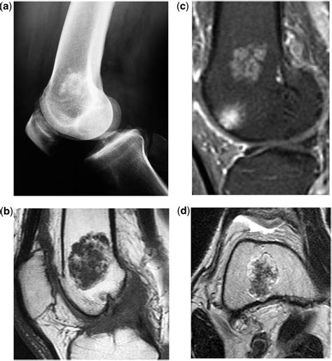 Sprain Of The Knee While Jogging On Radiographs Lateral View A A