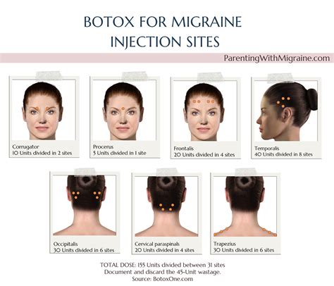 Migraine Botox Injection Sites Diagram
