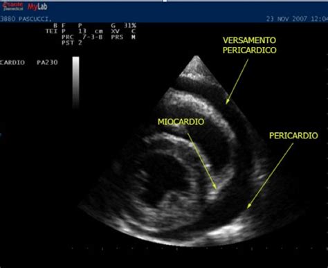 Pericarditis is inflammation of the pericardium (the fibrous sac surrounding the heart). Pericardite, terapia e colchicina, ECG e diagnosi