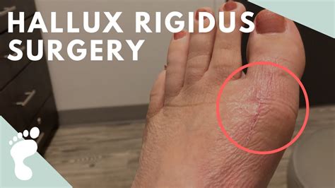 Hallux Rigidus Surgery Youtube