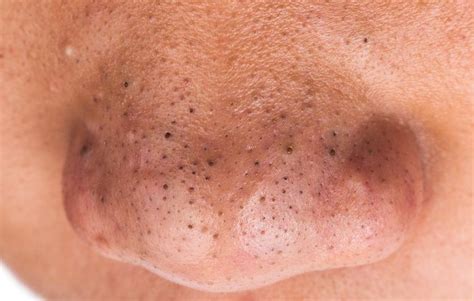 We have a great source of natural remedies that work well with most of the people's skin condition. How to Get Rid of Blackheads on Your Nose | Men's Health