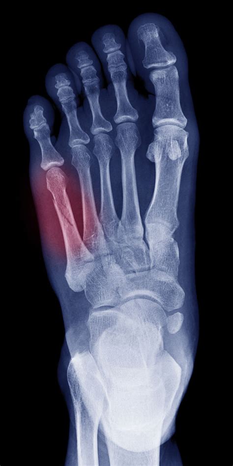 Stress Fractures Ottawa Foot Clinic