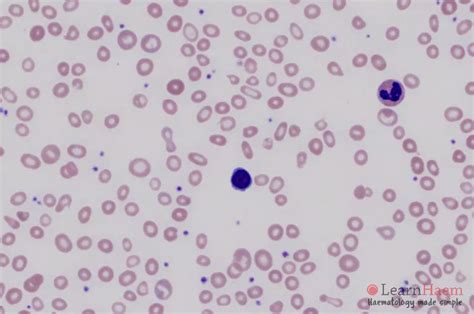 Microcytosis Learnhaem Haematology Made Simple