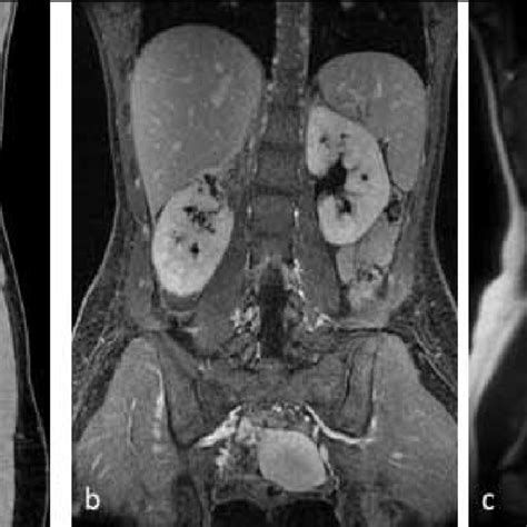 Renal Urine Leak And Urinoma In A Year Old Man Who Sustained Right Download Scientific