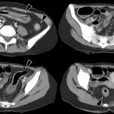 Figure1 Contrast Enhanced Abdominal CT Images At Admission The Images