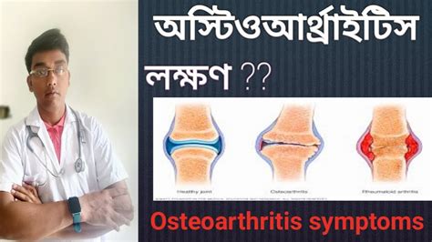 অস্টিওআর্থ্রাইটিস লক্ষণ Symptoms Of Osteoarthritis Youtube