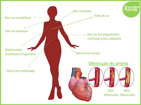Um enfarte do miocárdio origina sempre uma zona do coração que funciona mal, situação que pode ser mais ou menos grave consoante a zona atingida. Infarto fulminante - A menopausa pode ser um fator de risco!