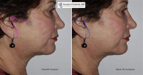 Neck Lift Vs Facelift Cosmetic Surgery