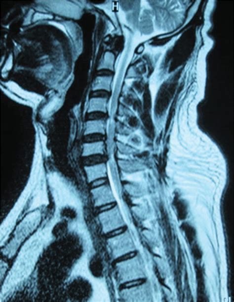 A Cervical Magnetic Resonance Imaging Mri Of An Illustrative Case