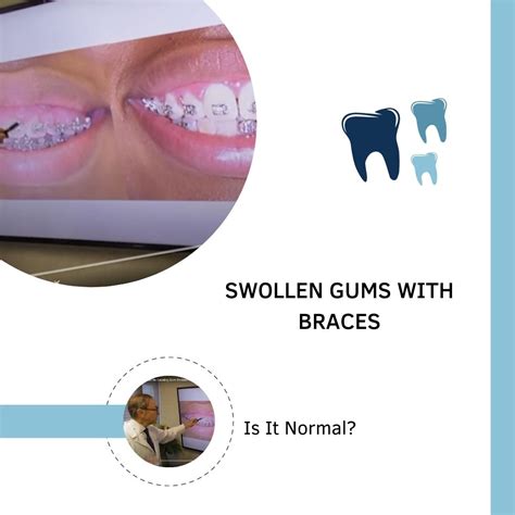 Swollen Gums With Braces Is It Normal Dental Pickup