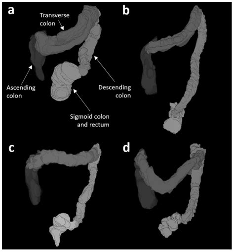 Diagnostics Free Full Text Colonic Volume Changes In Paediatric