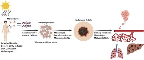 Melanoma Metastasis Three Routes Of Primary Melanoma Dissemination
