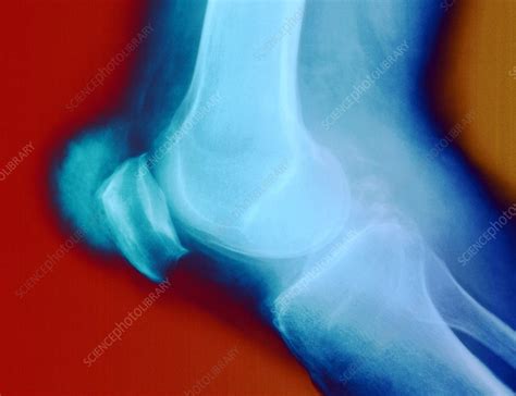 Knee With Gout X Ray Stock Image C0215429 Science Photo Library