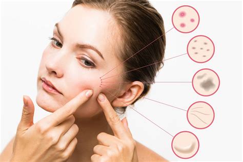 The first step, says shamban, is to realize that you're doing it — and then take measures to stop. How to treat acne problem the right way