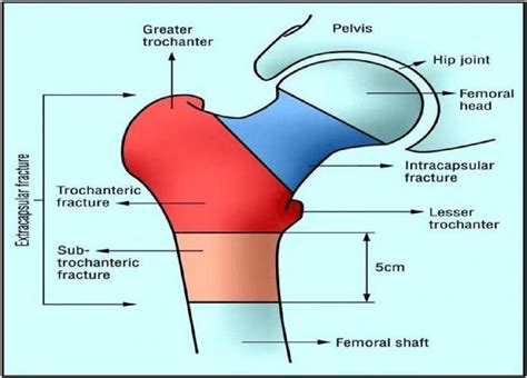 Classification Of Hip Fractures 1 Femoral Neck Download