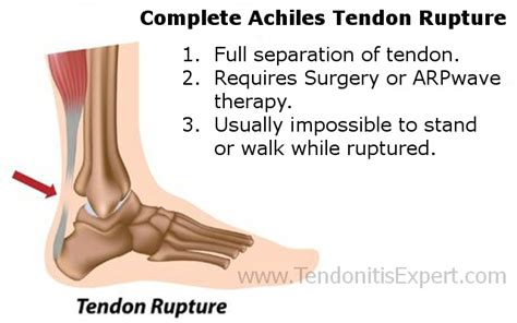 Torn Achilles Tendon Heal Fast Or Heal Slow After Achilles Tendon Surgery