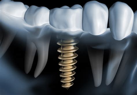 Dental Implants Thomas E Wright Iii Dds Houston Periodontist