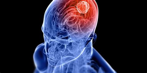 6 Brain Tumor Warning Signs You Should Know Mather Hospital