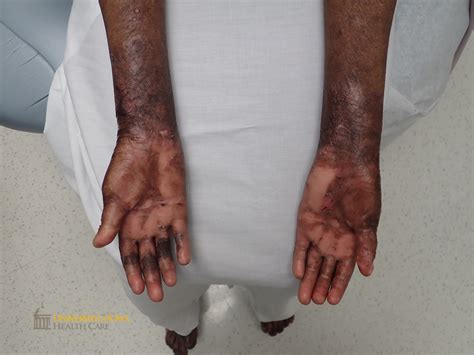 Pink Scaring Of Bilateral Palms With Focal Areas Of Erosion Click