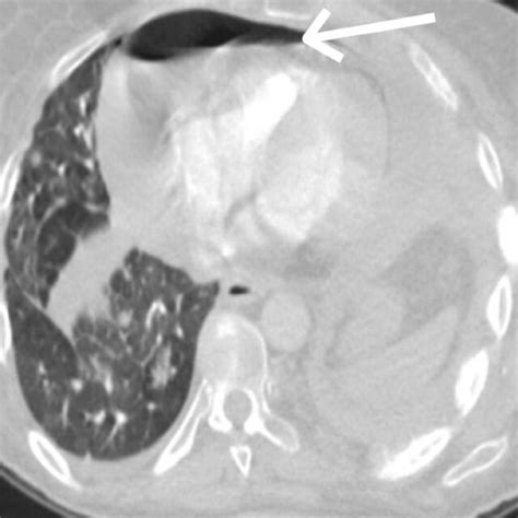 A Spiral Ct Pulmonary Angiogram Showing Heterogeneous Soft Tissue Mass