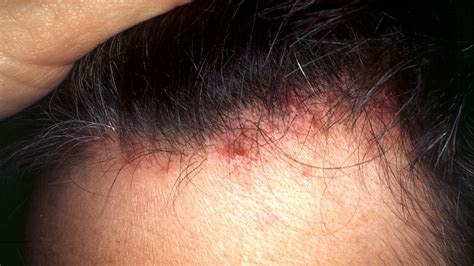 Red Rash On Scalp And Hair Loss Diagnosis Of Scalp Rashes Dermnet Nz