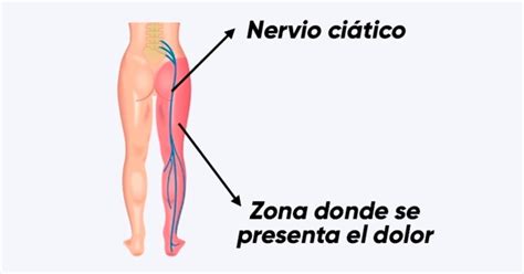 Vulvodinia se va asociada al dolor crónico y escozor de la vulva. Cómo identificar y tratar el nervio ciático inflamado ...