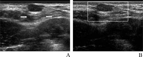 Trichilemmal Cyst Clinical And Sonographic Features He 2019