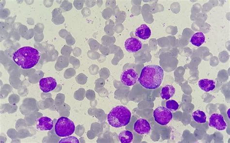 Bone Marrow Aspirate Smear Showing Paucity Of Erythroid Precursors