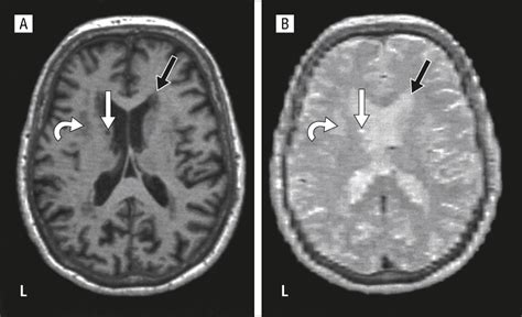 White Matter Lesions Are Prevalent But Differentially Related With