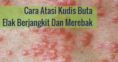 Kudis termasuk jenis penyakit kulit yang diakibatkan oleh tungau atau bakteri yang masuk ke dalam lapisan kulit. Cara Mengatasi Kudis Buta Dengan Berkesan Elak Merebak Dan ...