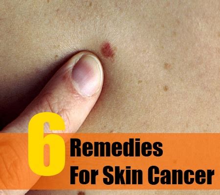 We know that exposure to some things in the environment can contribute too, such as certain chemicals. 6 Best Herbal Remedies For Skin Cancer - How To Treat Skin ...