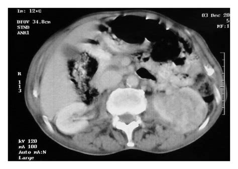 Abdominopelvic Ct A Image Showing 8 Cm Large Mass On The Left Kidney