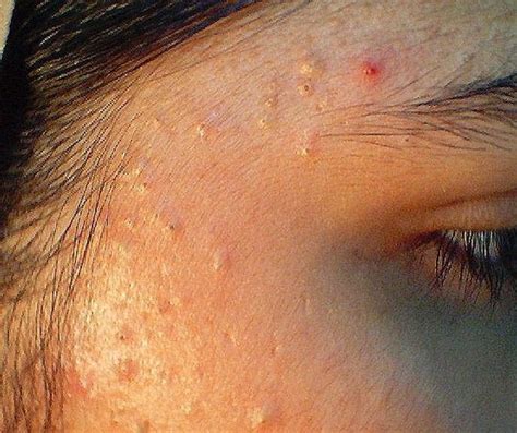 comedonal acne pictures 5 | Comedonal acne, Acne pictures, Acne