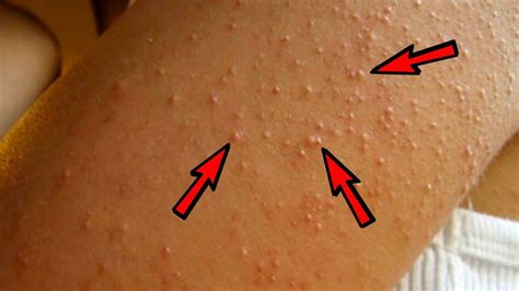 Natural Treatment To Get Rid Of Keratosis Pilaris Chicken Skin Youtube