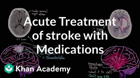 Acute Treatment Of Stroke With Medications Nclex Rn Khan Academy