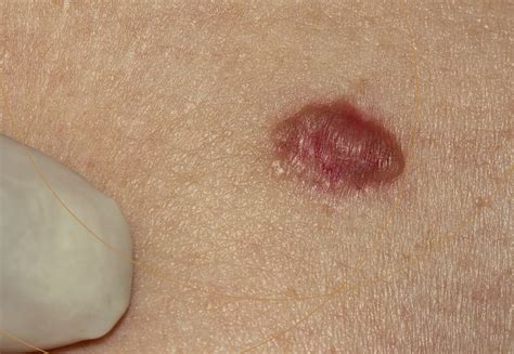 Câncer De Pele Não Melanoma Dra Ladia