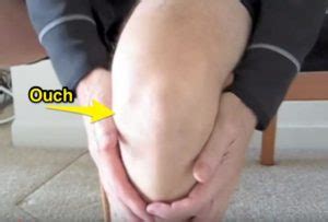When an acl tear occurs, you will either feel or hear a popping in the knee Do you need surgery for a torn ACL?