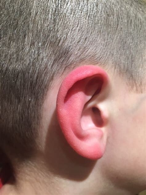 Why You Should Hear About The Red Ear Syndrome