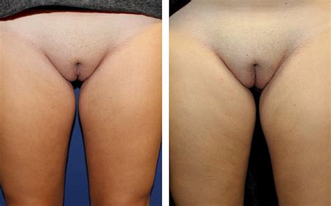 Labiaplasty At Center For Dermatology Plastic Surgery In Greater Phoenix Area