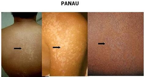 Panau merupakan penyakit kulit yang tidak berbahaya dan hanya menyebabkan tompok putih ataupun gelap pada kulit. .:essence of zarraz paramedical: Panau