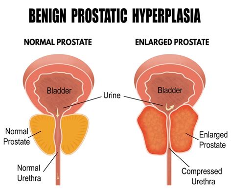Benign Prostatic Hyperplasia BPH Familydoctor Org