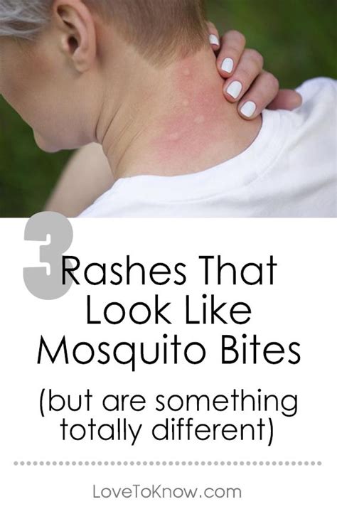 Rash That Looks Like Mosquito Bites Lovetoknow Skin Rashes Pictures Skin Infection Remedy