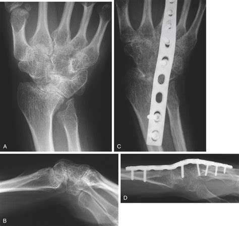 Total Wrist Fusion Musculoskeletal Key