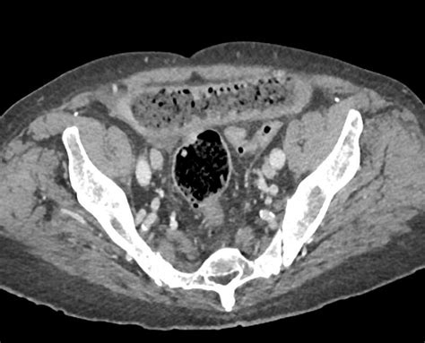 Distal Small Bowel Obstruction With Ischemic Bowel Small Bowel Case