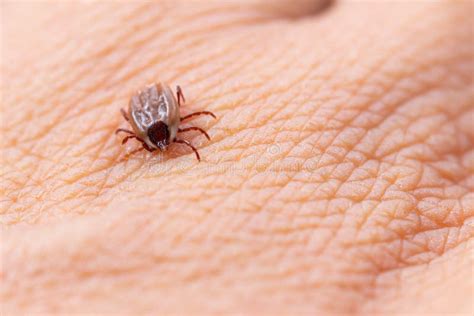 Tick Filled With Blood On Human Skin Stock Image Image Of Bloodsucker