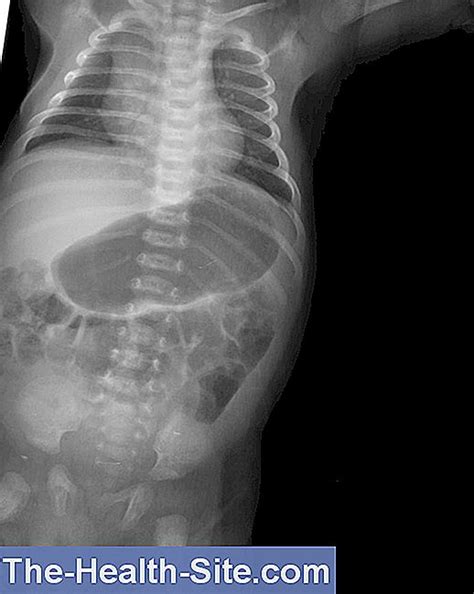 La estenosis es un término utilizado para denotar la constricción o estrechamiento de un orificio o conducto corporal. ESTENOSIS PILORICA PDF