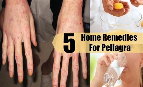 5 Pellagra Home Remedies Natural Treatments And Cure Herbal Supplements
